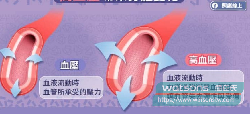 血管內壓力變化與心臟事件風險
