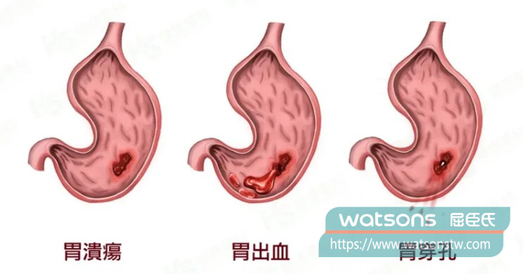 臨床研究怎麼說？必利勁與胃傷害的關聯性資料